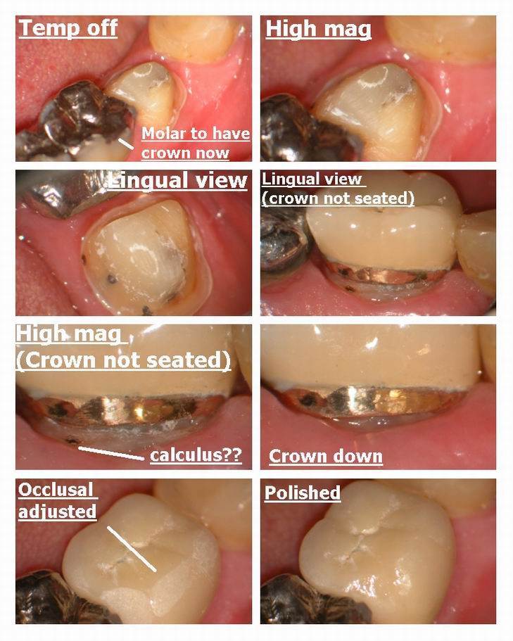 Final Resize of crown on laser buildup.jpg